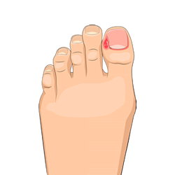 Ingrowing toenails